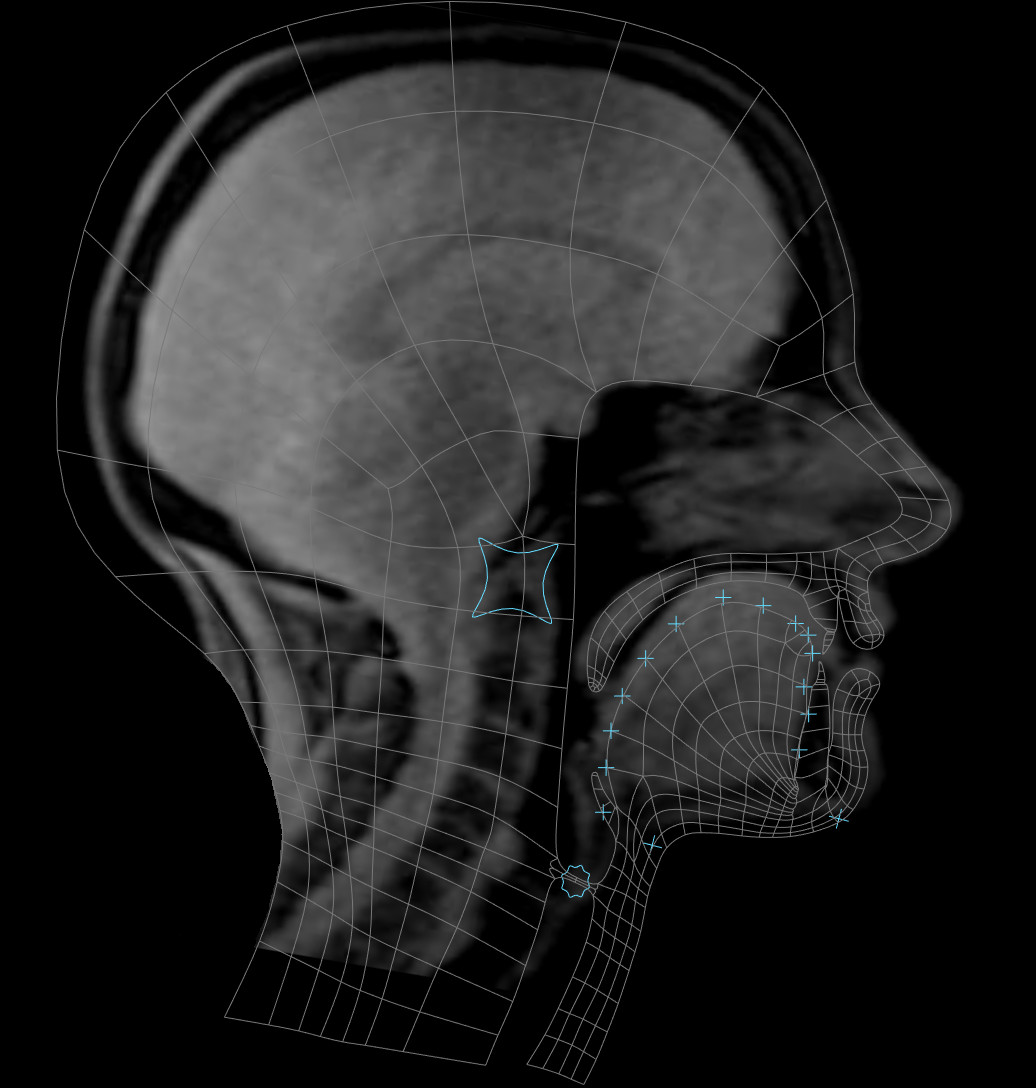 Animation rig superimposed on the MRI video frame