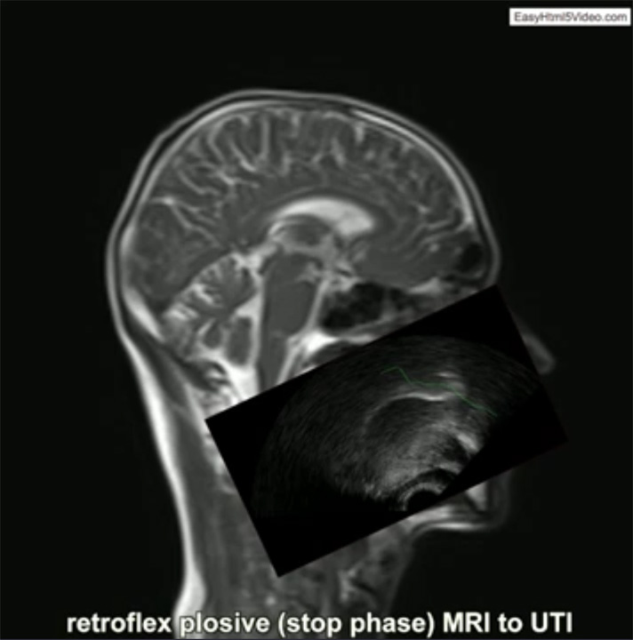 Comparing Ultrasound Tongue Imaging and Magnetic Resonance Imaging - still frames